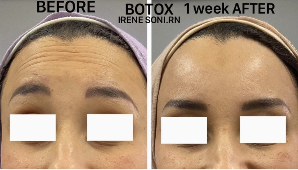 Botox Hyaluron The Before After Photos That Will Make You Run To The Clinic - s0pp4yg
